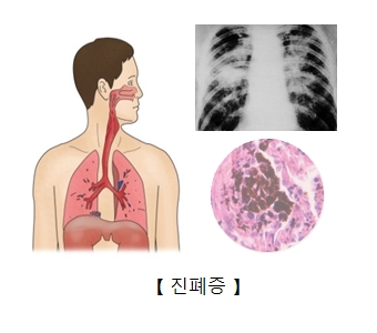 진폐증