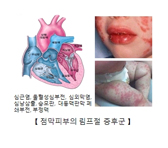 점막피부의 림프절 증후군