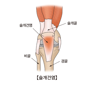 슬개건염