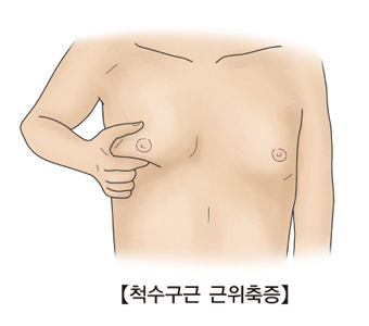 척수구근 근위축증