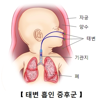 태변흡인 증후군