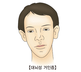 대뇌성 거인증