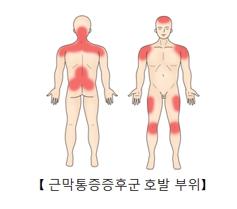 근막통증증후군