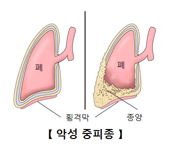 악성 중피종