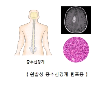 원발성 중추신경계 림프종