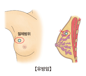 유방암