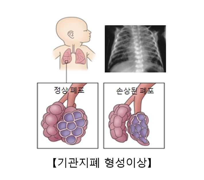 기관지폐 이형성증