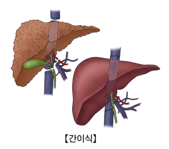 간이식 후 상태