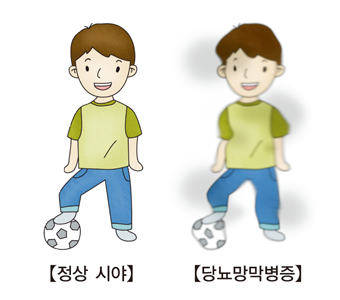 당뇨망막병증