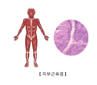 피부근육염