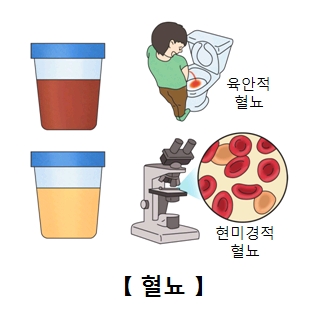 발작성야간혈색소뇨증