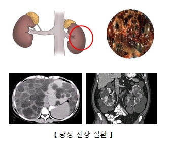 낭성 신장 질환