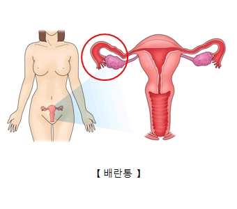 배란통