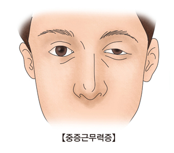 중증근무력증