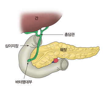 췌장 전이암