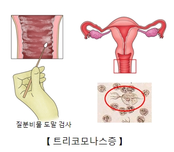 트리코모나스 증