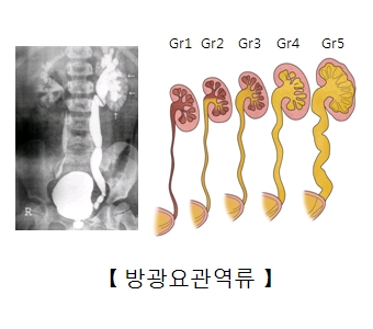 방광요관역류