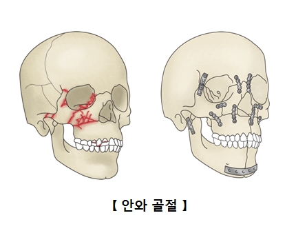 안와골절