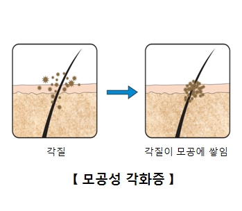 모공성 각화증