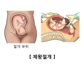 제왕절개