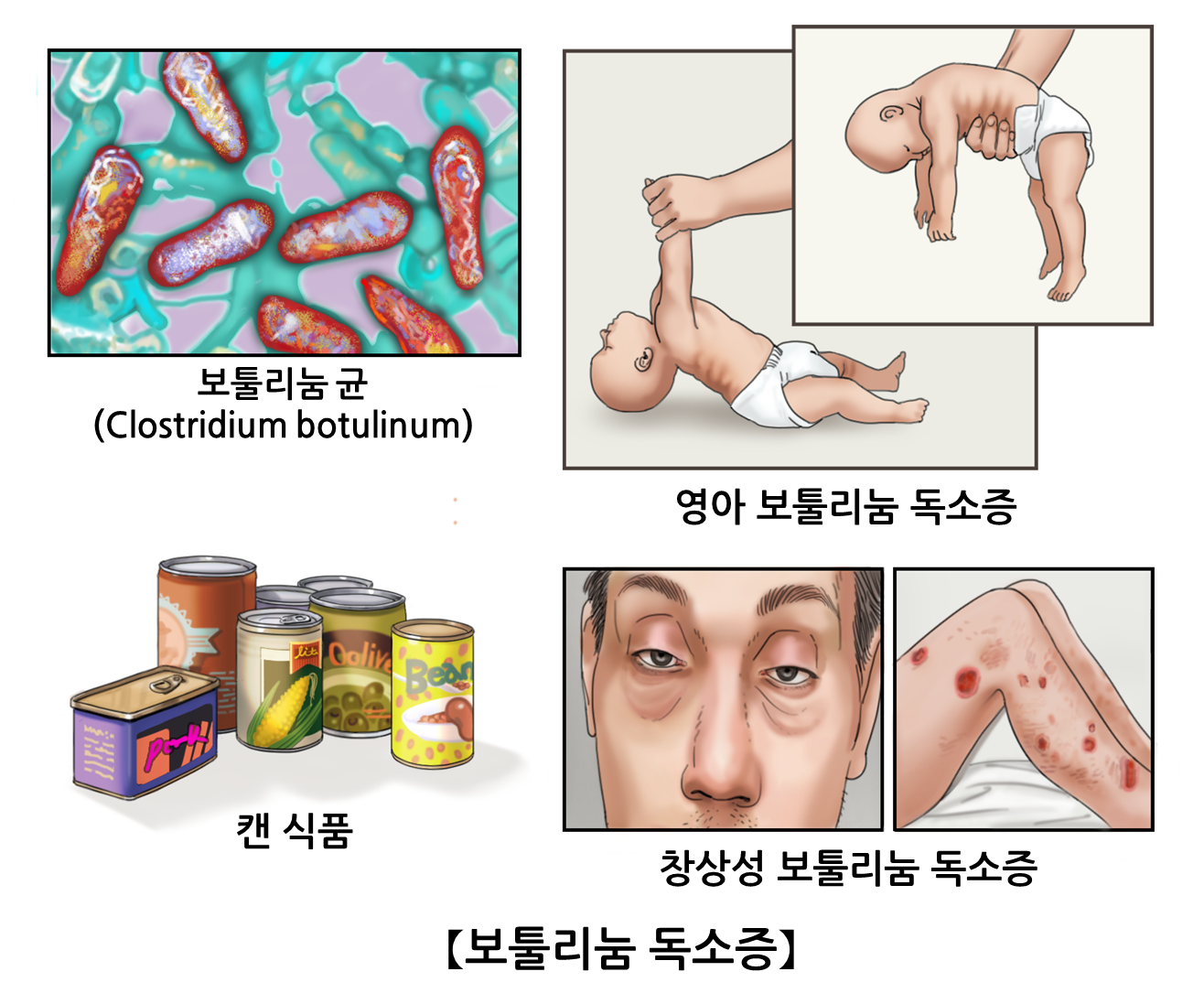 보툴리눔 독소증