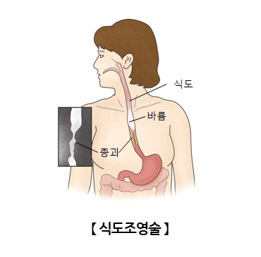 식도조영술