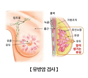 유방암