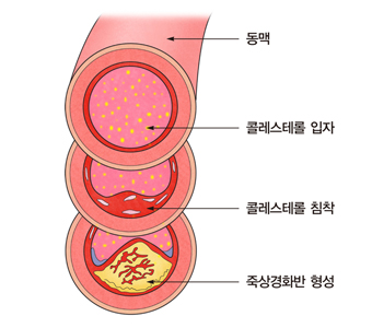 HDL.