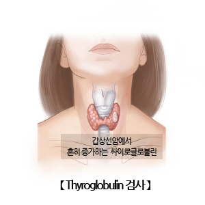 갑상선글로불린