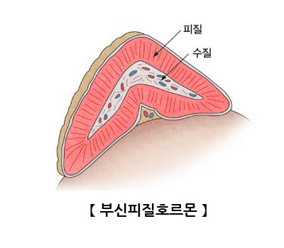 부신피질호르몬