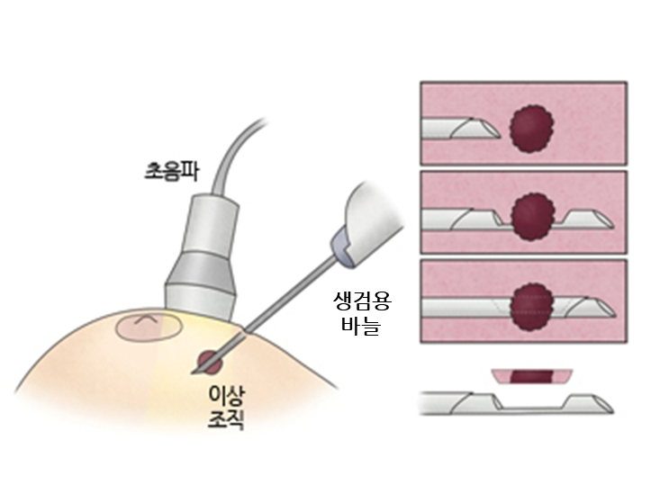 입체 정위 진공 보조 유방 생검술