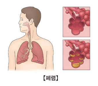 폐렴에 대한 예시